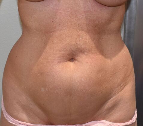 Tummy Tuck (Abdominoplasty): Case 469 - Before