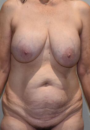 Mommy Makeover Case 299 - Before