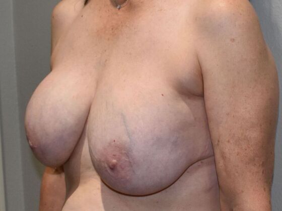 Breast Revision: Case 241 - Before