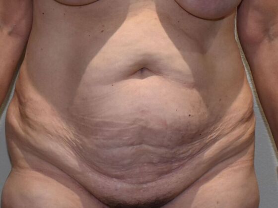 Tummy Tuck (Abdominoplasty): Case 470 - Before
