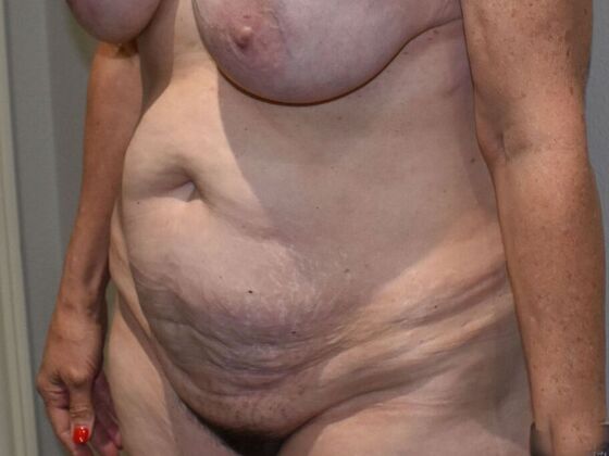 Tummy Tuck (Abdominoplasty): Case 470 - Before