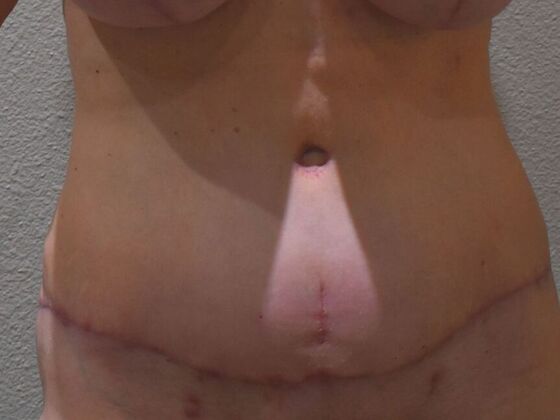 Tummy Tuck (Abdominoplasty): Case 470 - After