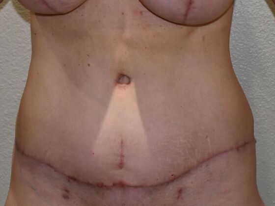 Tummy Tuck (Abdominoplasty): Case 470 - After