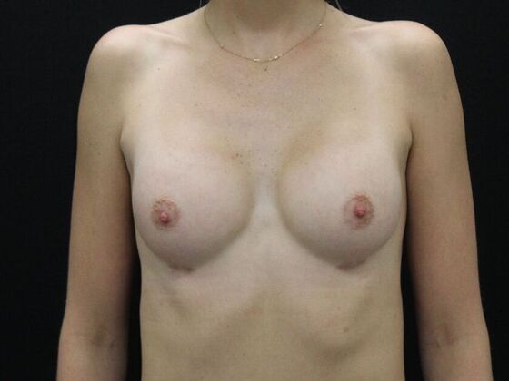 Breast Augmentation: Case 104 - After