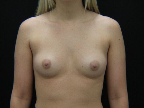 Breast Augmentation Case 105 - Before