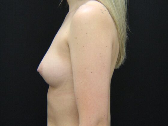 Breast Augmentation: Case 105 - Before