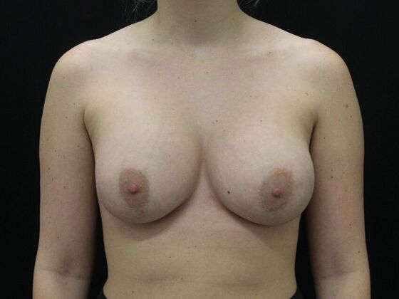Breast Augmentation Case 105 - After