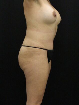 Tummy Tuck: Case 23 - After