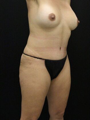 Tummy Tuck: Case 23 - After