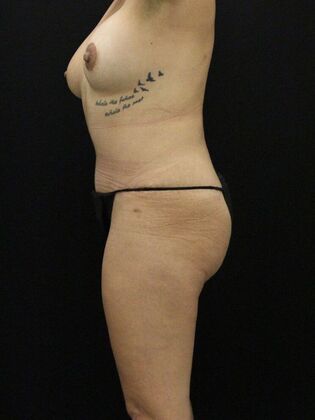 Tummy Tuck: Case 23 - After