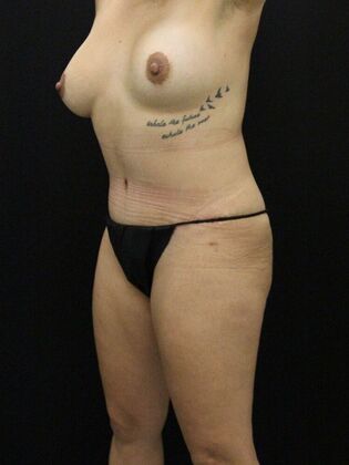 Tummy Tuck: Case 23 - After