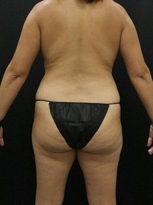 Tummy Tuck: Case 23 - Before