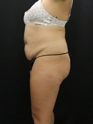 Tummy Tuck: Case 23 - Before