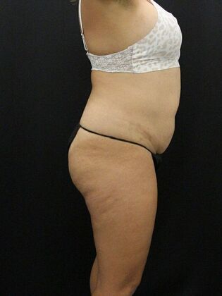 Tummy Tuck: Case 23 - Before
