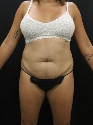 Tummy Tuck Case 23 - Before
