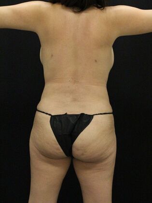 Liposuction Case 32 - After