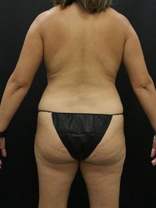 Liposuction Case 32 - Before