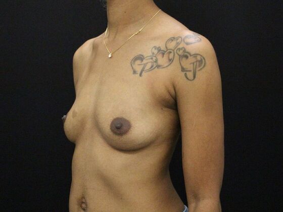 Breast Augmentation: Case 29 - Before