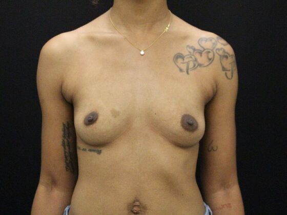 Breast Augmentation Case 29 - Before