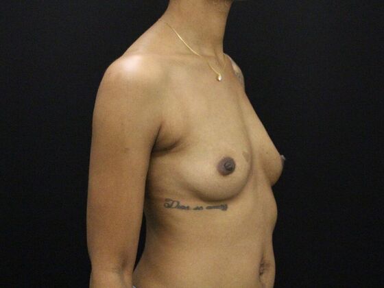 Breast Augmentation: Case 29 - Before