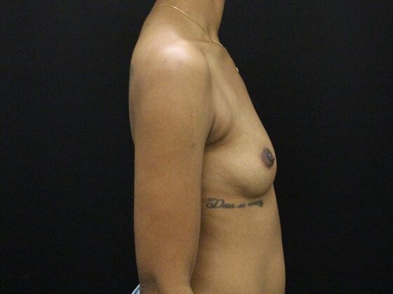 Breast Augmentation: Case 29 - Before