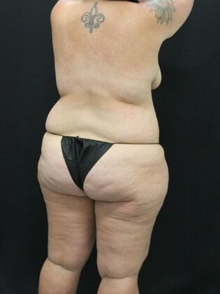 Liposuction: Case 33 - Before