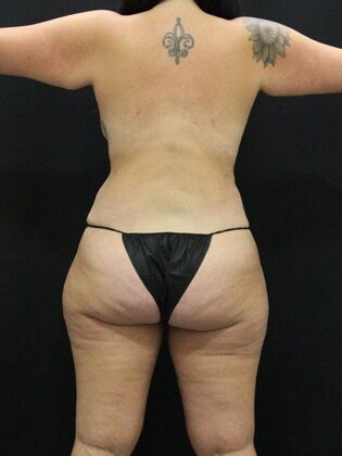 Liposuction Case 33 - After