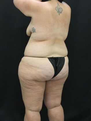 Liposuction: Case 33 - Before