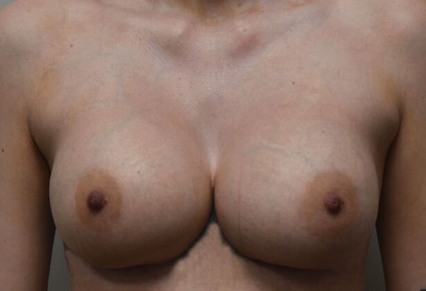 Breast Revision: Case 242 - After