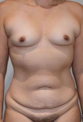 Mommy Makeover Case 300 - Before