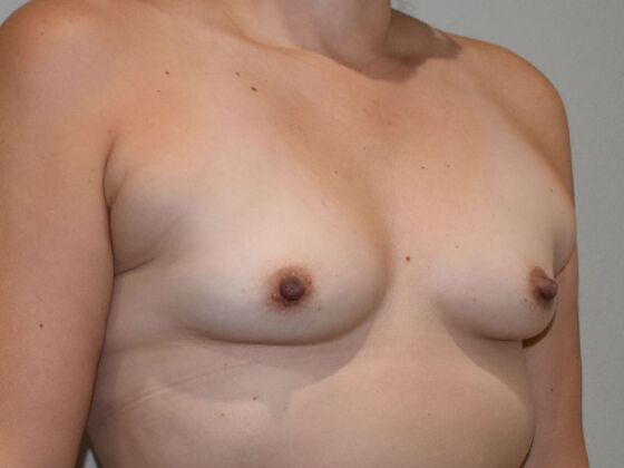Breast Augmentation: Case 758 - Before