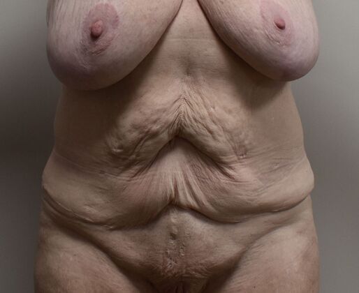 Tummy Tuck (Abdominoplasty): Case 471 - Before