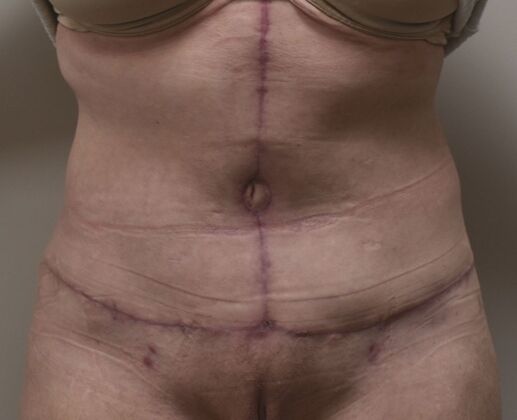 Massive Weight Loss : Case 148 - After