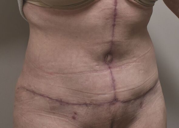 Massive Weight Loss : Case 148 - After