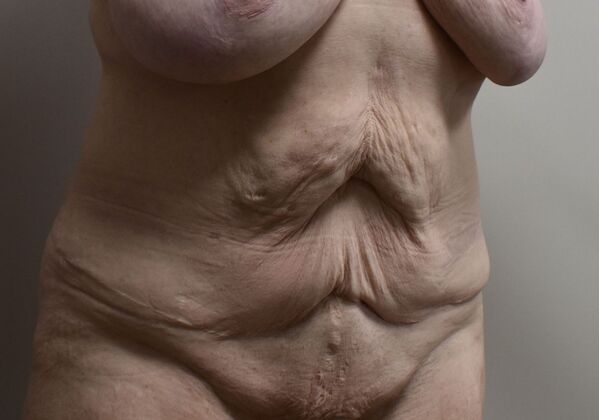 Massive Weight Loss : Case 148 - Before