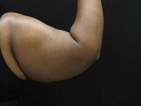 Arm Lift & Reduction: Case 10 - Before