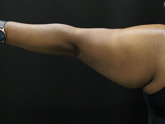 Arm Lift & Reduction: Case 10 - Before