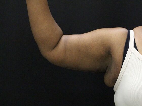 Arm Lift & Reduction: Case 10 - After