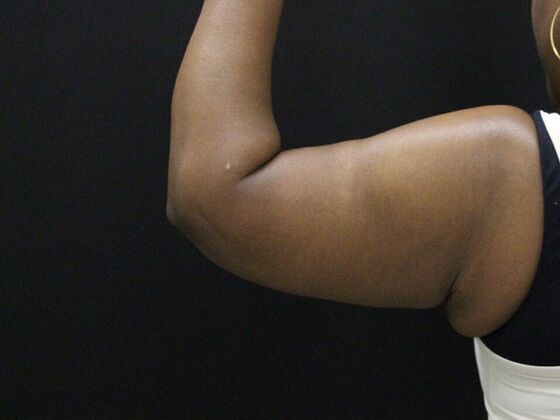 Arm Lift & Reduction: Case 10 - After