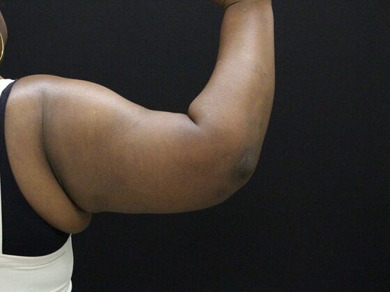 Arm Lift & Reduction: Case 10 - After