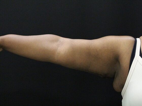 Arm Lift & Reduction Case 10 - After