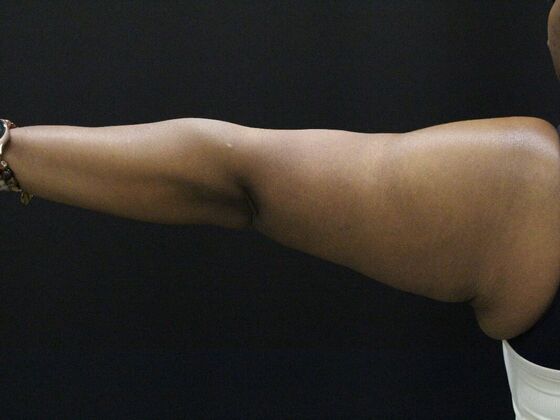 Arm Lift & Reduction: Case 10 - After