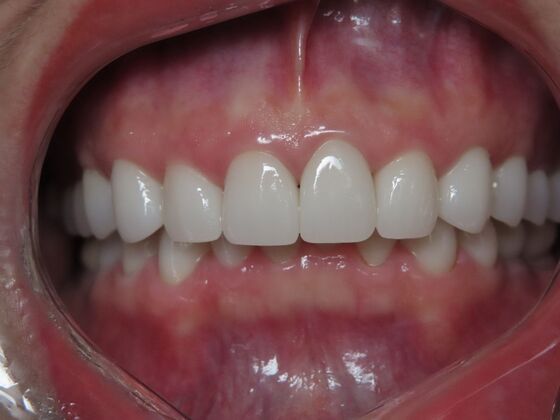 Crowns Case 1 - After