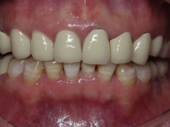 Crowns Case 1 - Before