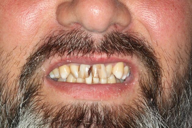 Porcelain Crowns and Veneers: Four Zirconia Crowns to Fix Broken Teeth - Before
