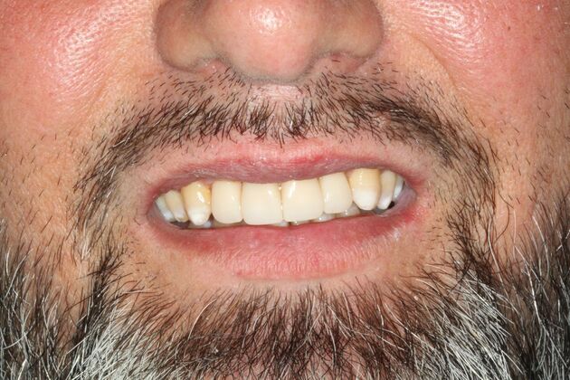 Porcelain Crowns and Veneers: Four Zirconia Crowns to Fix Broken Teeth - After