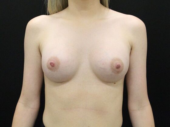 Breast Augmentation Case 106 - After