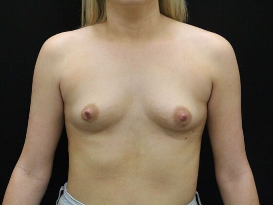 Breast Augmentation Case 106 - Before