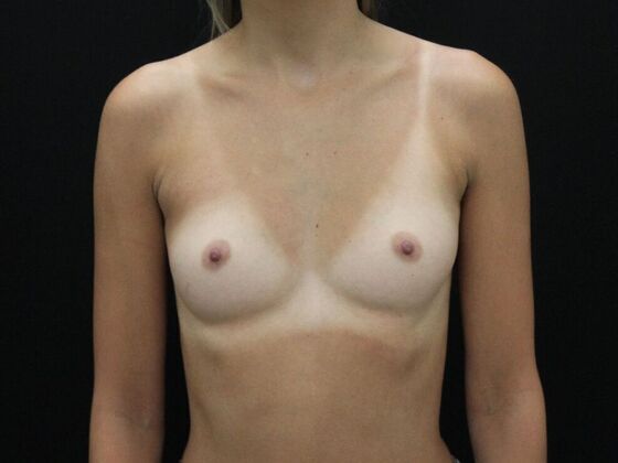 Breast Augmentation Case 107 - Before