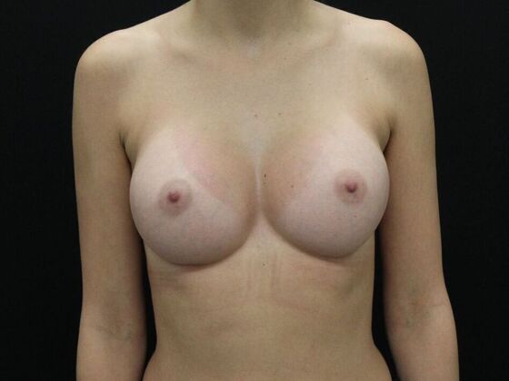 Breast Augmentation Case 107 - After